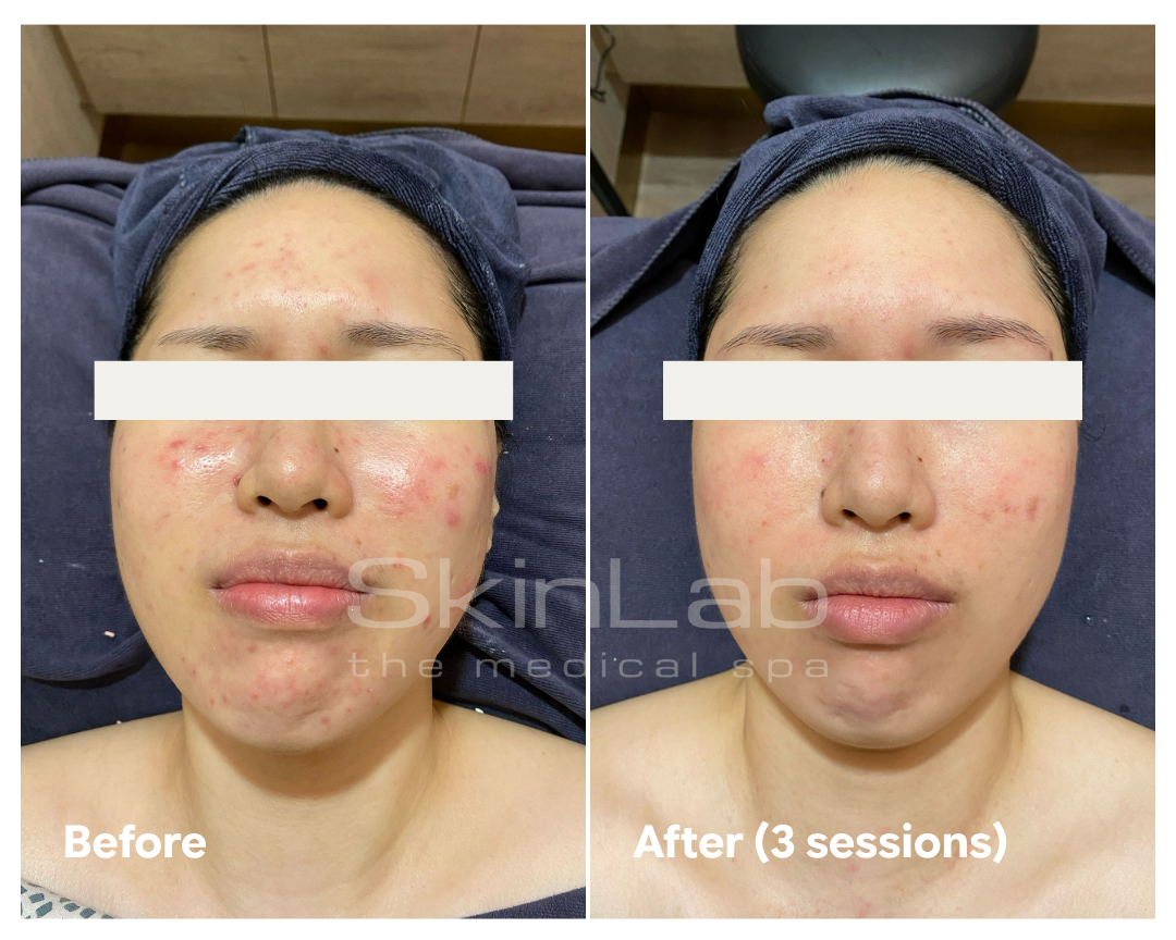SkinLab acne treatment result before treatment and after three sessions