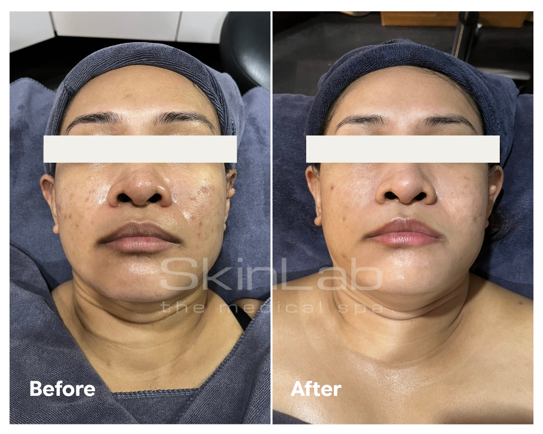 SkinLab acne scar treatment result before and after a course of treatment