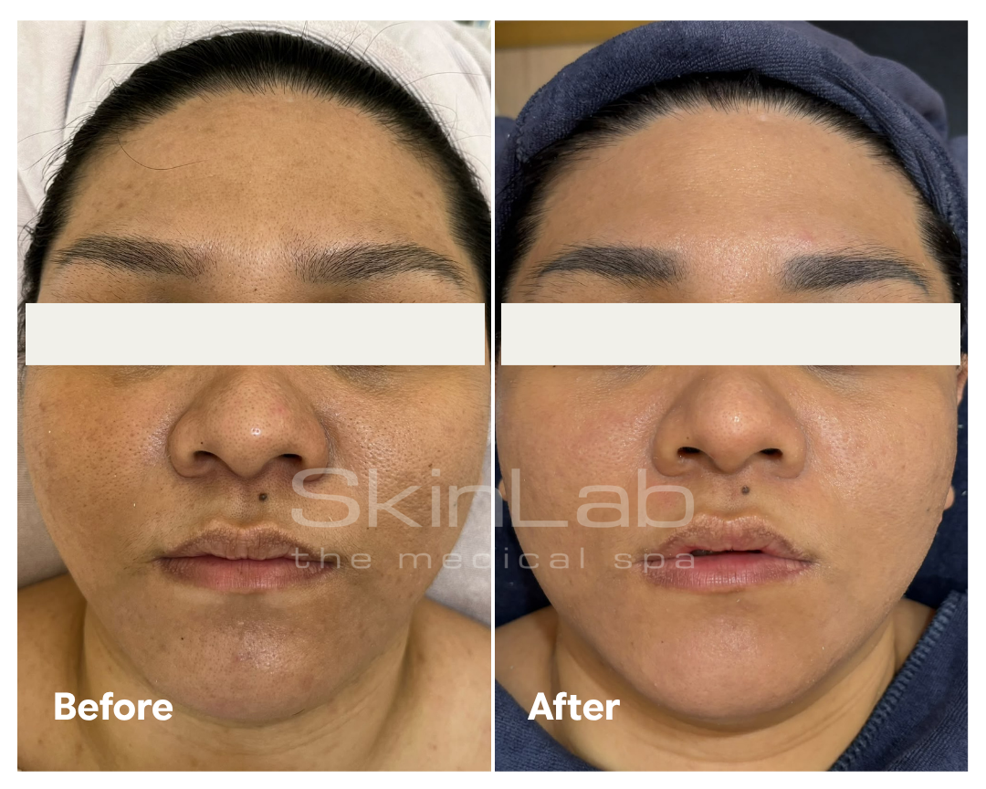 SkinLab dry skin treatment result before and after a course of treatment