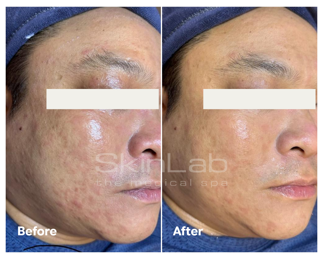 SkinLab oily skin treatment result before and after a course of treatment