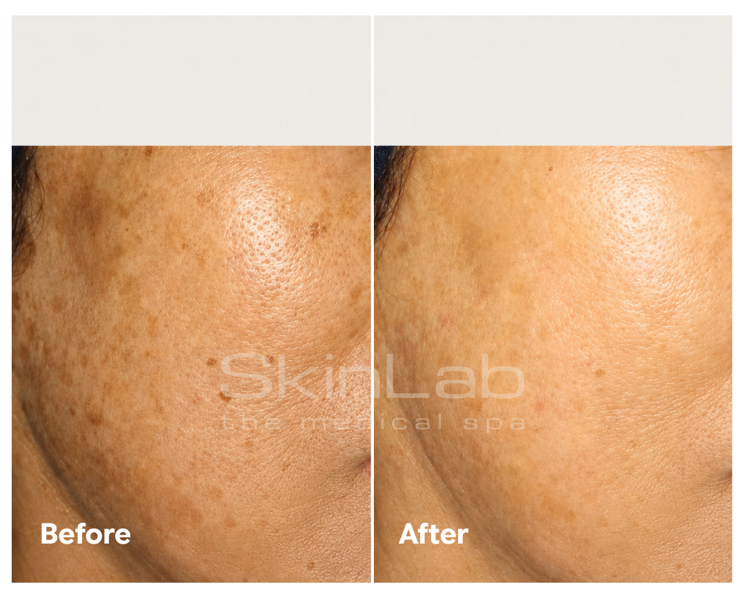SkinLab pigmentation treatment result before and after a course of treatment