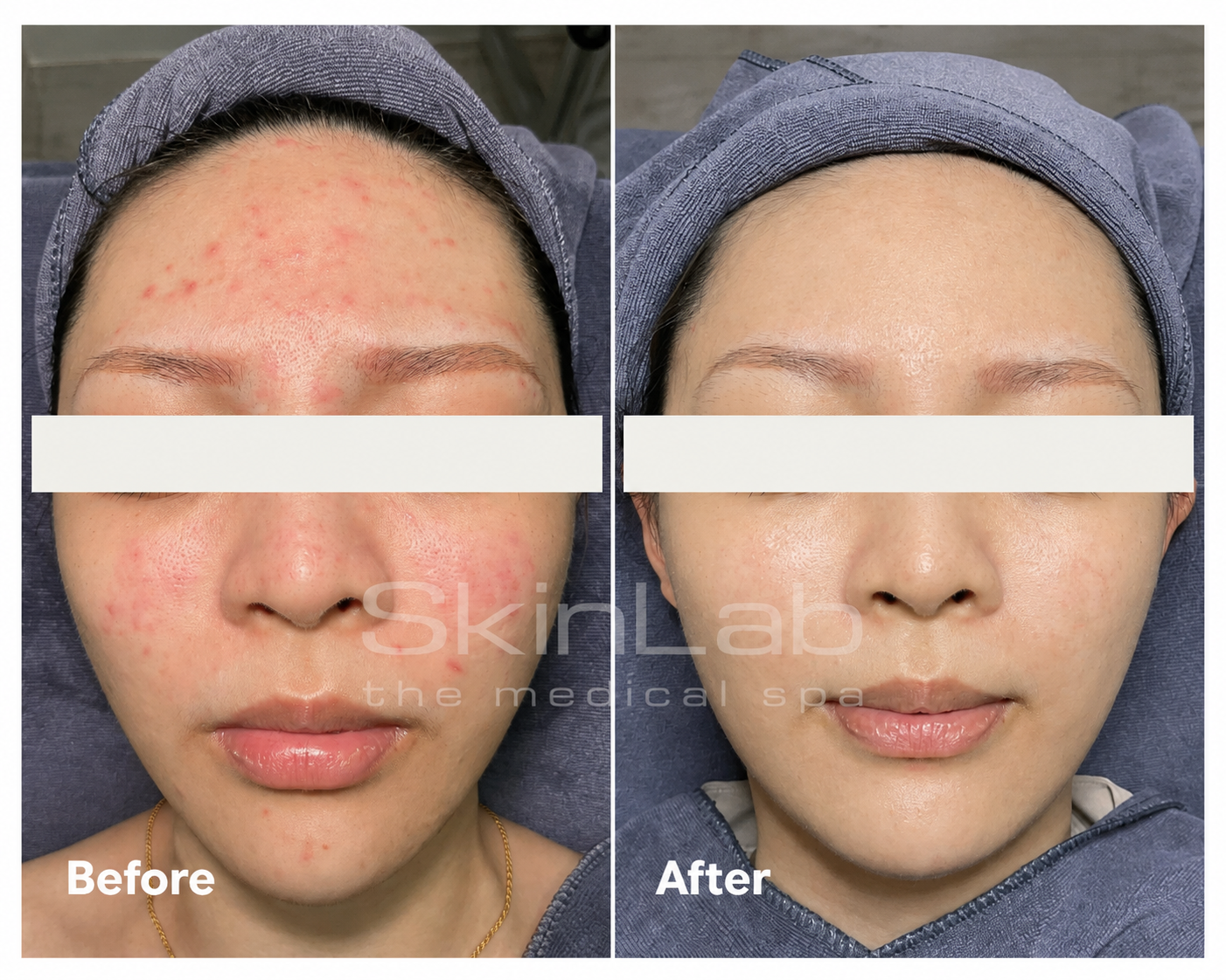 SkinLab sensitive skin treatment result before and after a course of treatment