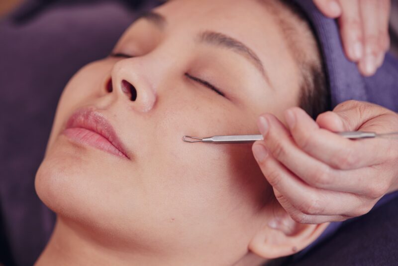 Professional extraction during an acne treatment