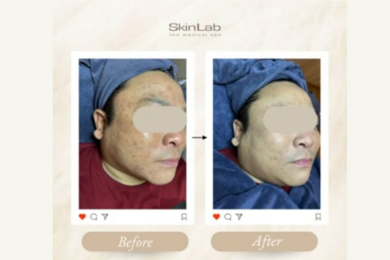 DermaCare-Facial-before-and-after