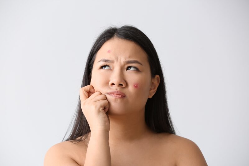 Are facials safe for acne-prone skin