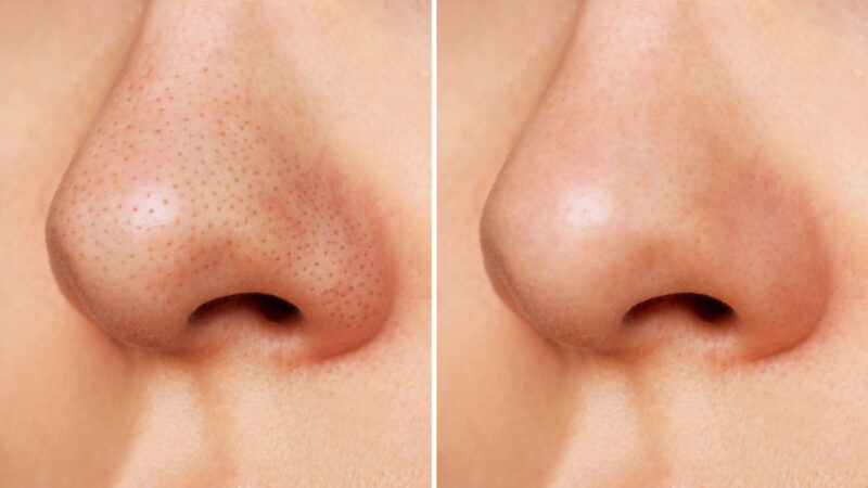 Best Habits To Prevent Blackheads