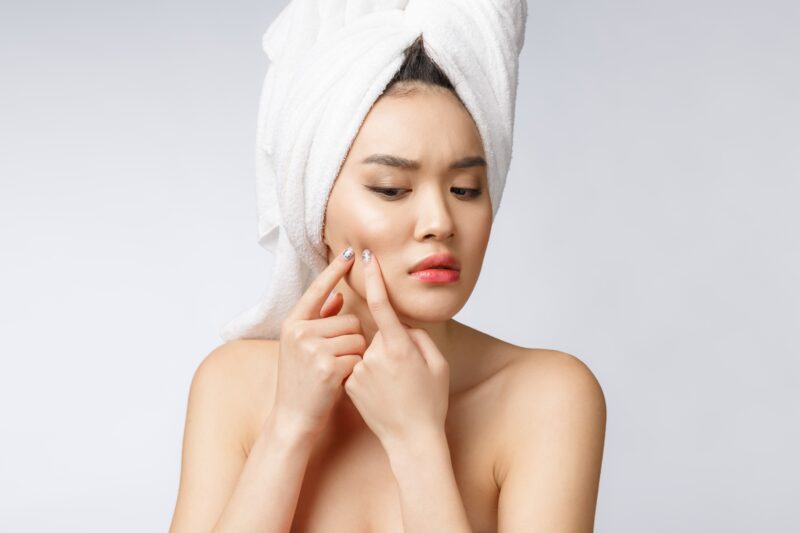 Common Acne Myths in Singapore Debunked