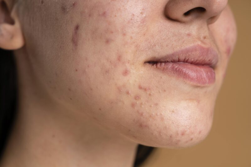 2024 Complete Guide to Acne Treatments