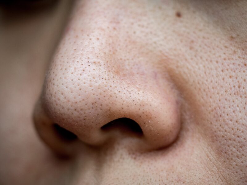 Blackheads