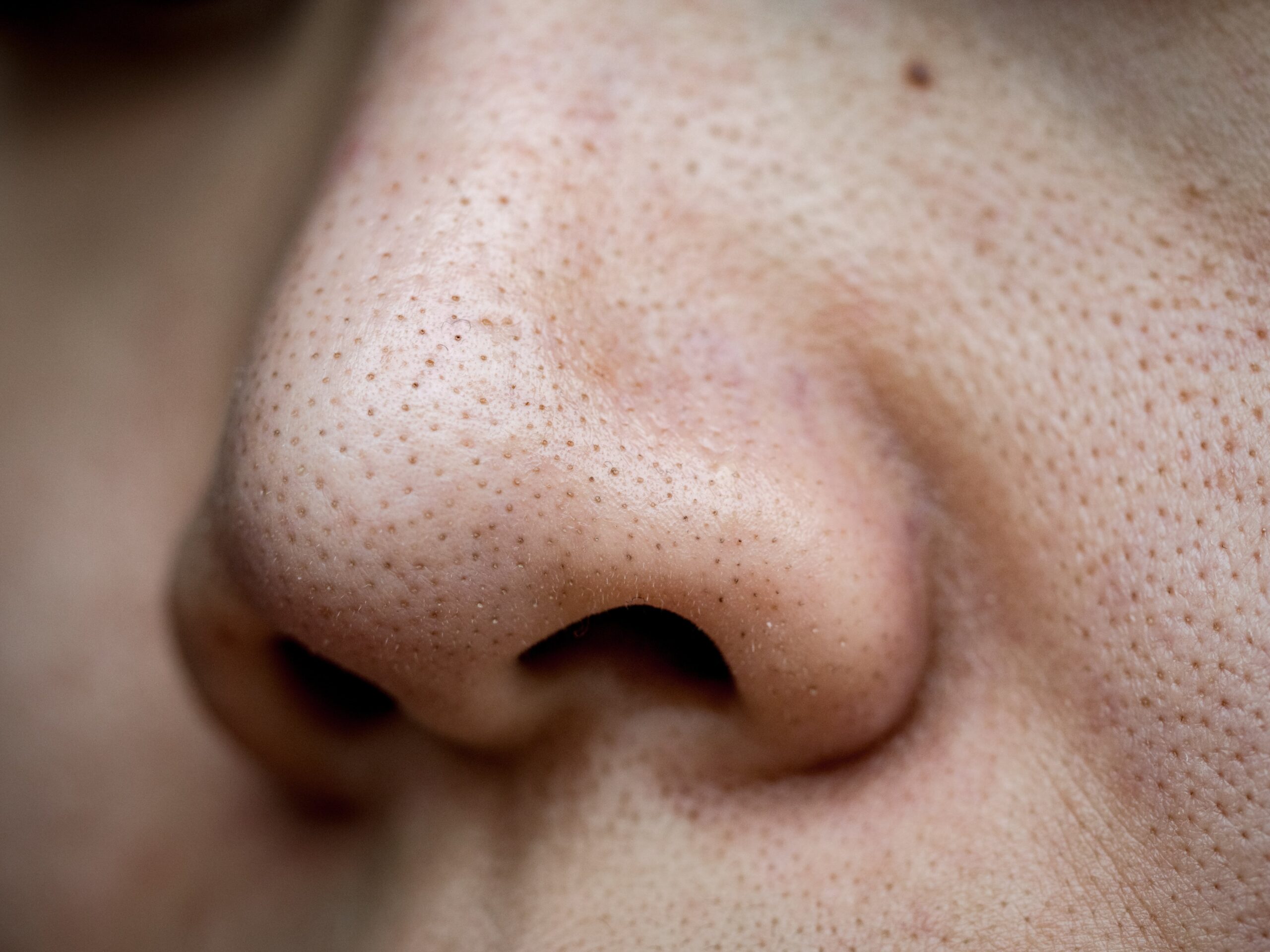 Why You Shouldn t Attempt Removing Blackheads Yourself