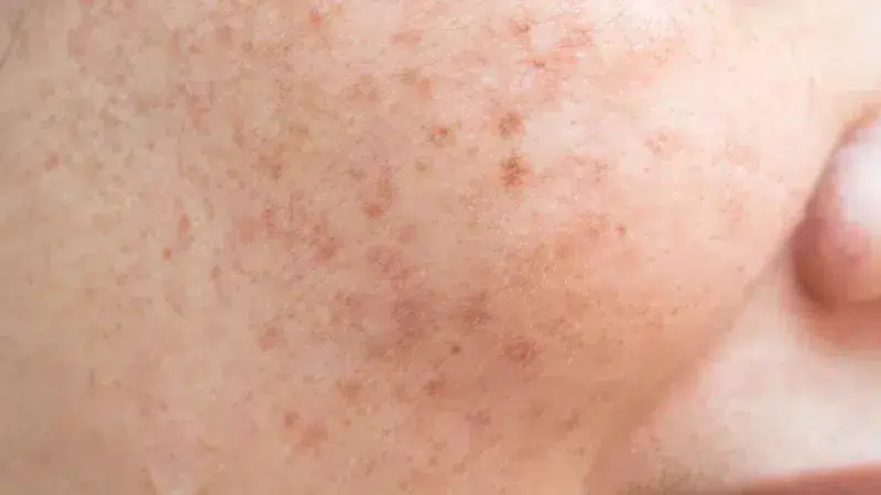 facials for pigmentation