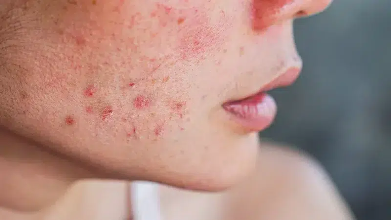 Sensitive skin care tips