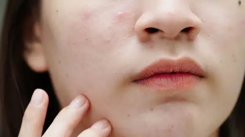 acne facial singapore