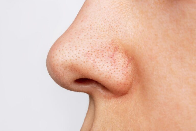 Read more about the article Guide to Choosing a Blackhead Removal Facial (All Skin Types)