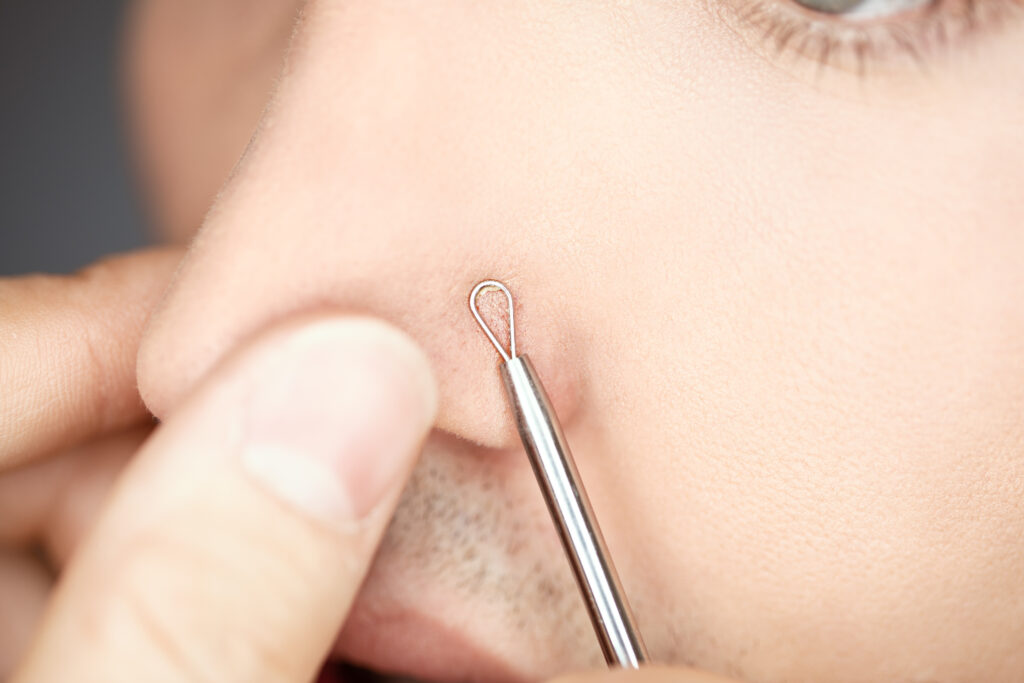 DIY Facial Extraction: Why It's Riskier Than You Think