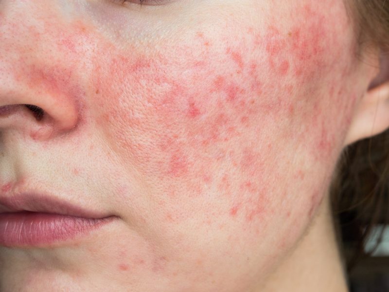 All You Need to Know About Azelaic Acid