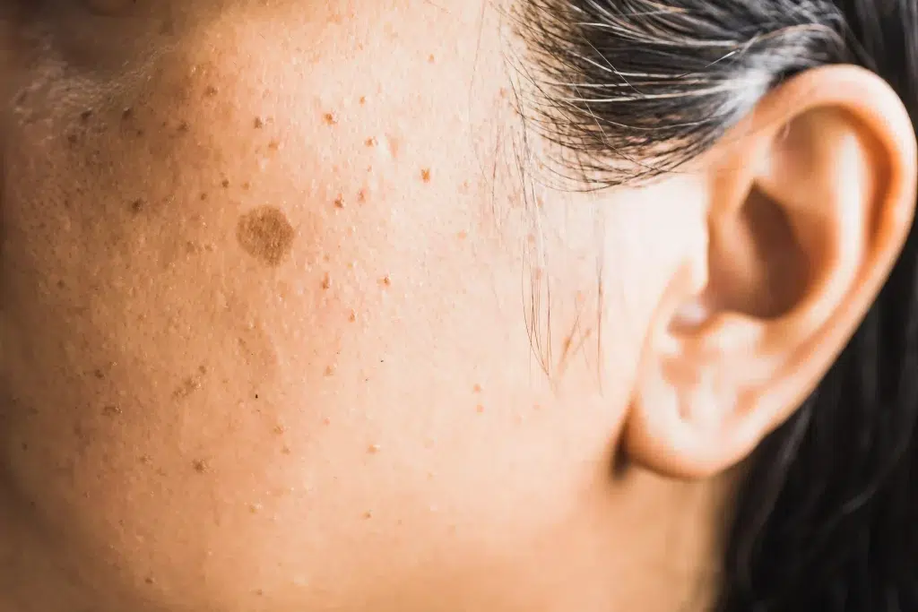 A woman with a dark patch on her face