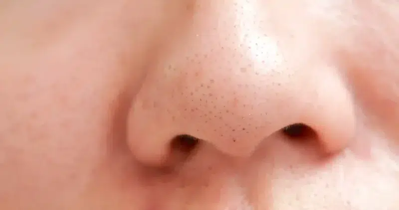 Blackheads on a woman’s nose due to clogged pores.