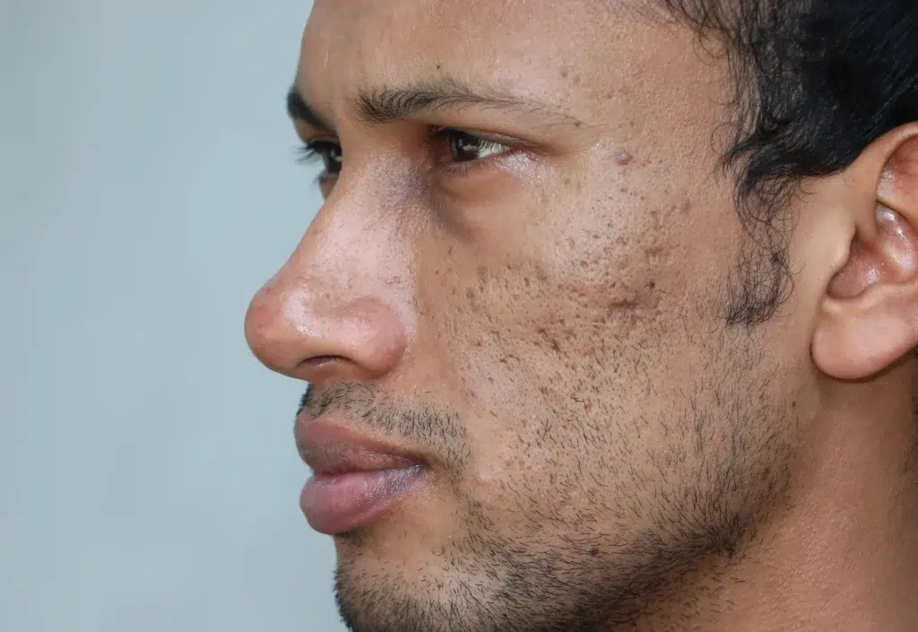 Treatment for acne scars.