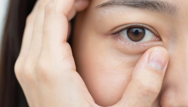 Closeup of a woman’s eye bag