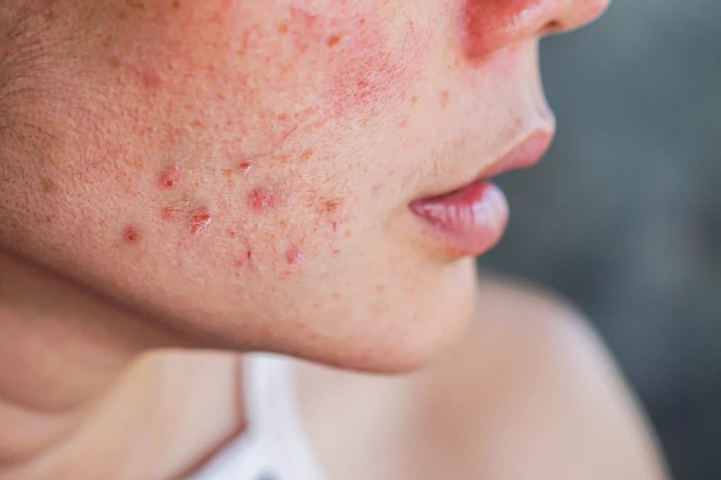 Closeup of acne on woman’s face